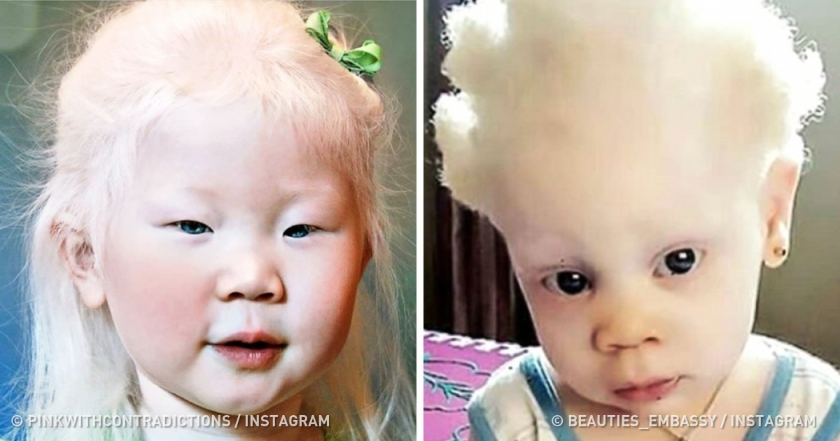 Découvre à quoi ressemblent les albinos de différentes origines à travers le monde