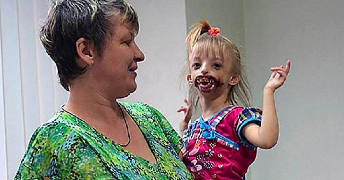 Une petite fille de 3 ans née sans lèvres est reniée par quasi toute sa famille.