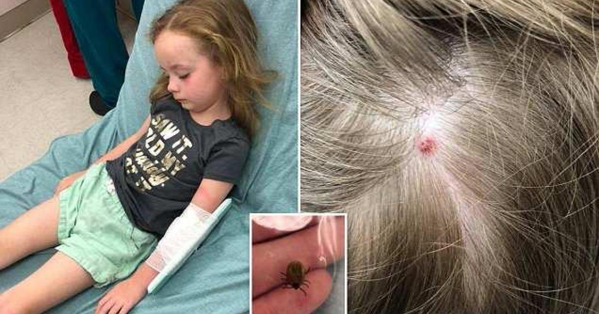 Une fillette de 5 ans est muette et paralysée pendant 12 heures. Les docteurs découvrent cette piqûre sur sa tête.