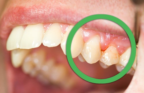 Des remèdes naturels pour les gencives et les dents — Améliore ta Santé