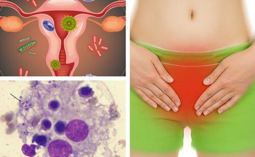 6 conseils pour soulager les mycoses vaginales — Améliore ta Santé
