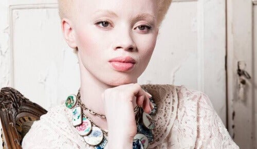 Albinisme : l’exemple émouvant de Thando Hopa — Améliore ta Santé