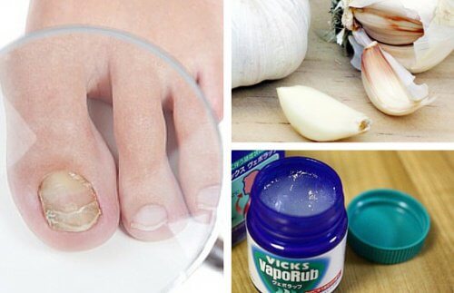 7 remèdes pour lutter contre les mycoses des ongles — Améliore ta Santé
