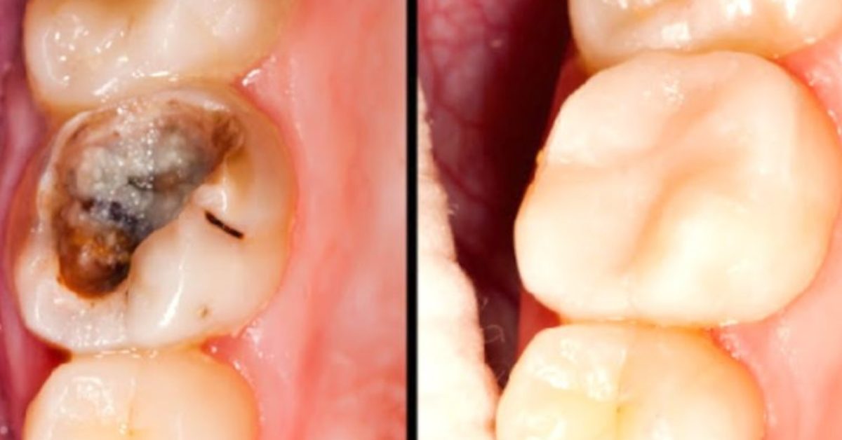 Des scientifiques ont découvert un médicament qui fait repousser les dents cassées