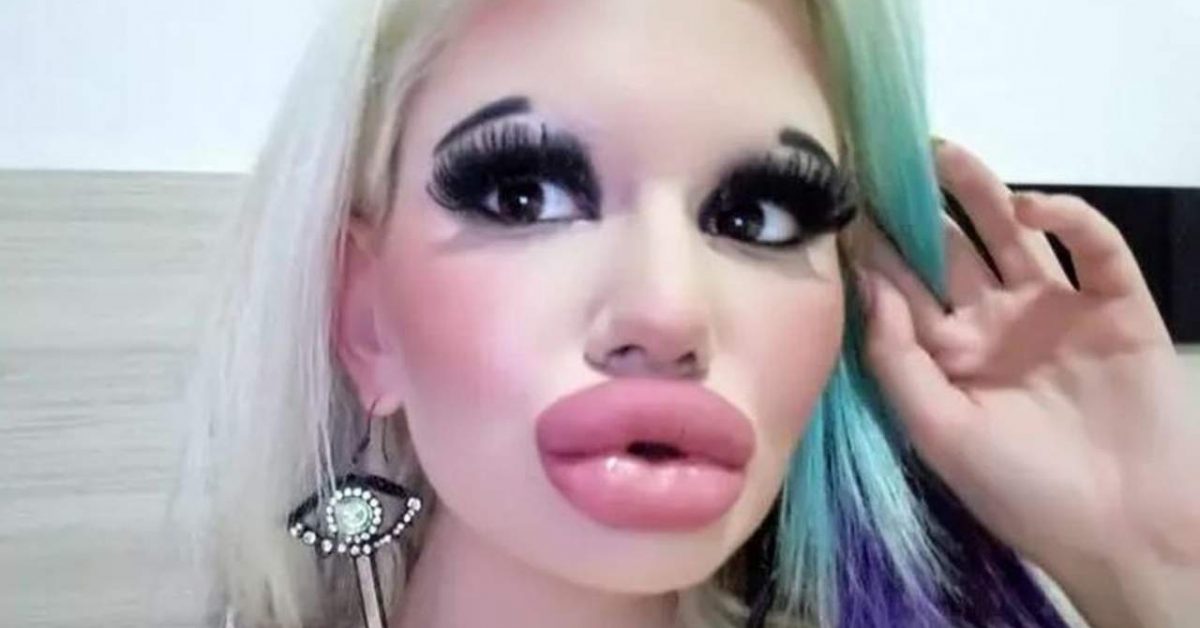 Une étudiante triple la taille de ses lèvres pour être “à la mode”