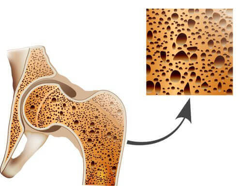 9 conseils pour lutter contre l’ostéoporose — Améliore ta Santé