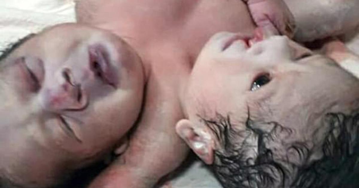 Une femme de 21 ans donne naissance à un bébé avec deux têtes et trois bras