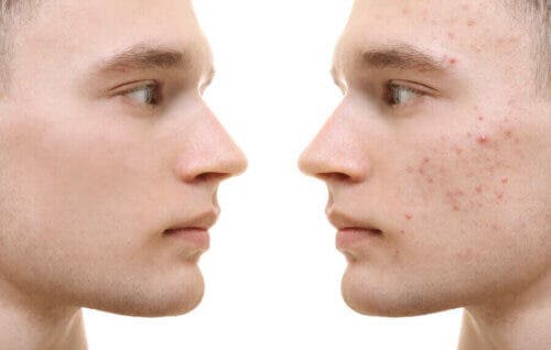 Curcuma contre l’acné : bénéfices et mode d’emploi – Améliore ta Santé