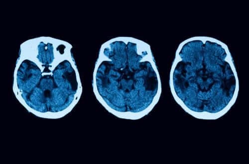 Atrophie corticale postérieure : diagnostic et traitement – Améliore ta Santé