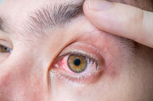 MÃ©lanome oculaire : symptÃ´mes et causes – AmÃ©liore ta SantÃ©