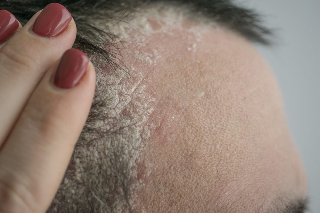 14 Remèdes Naturels Pour Venir à Bout Du Psoriasis Du Cuir Chevelu