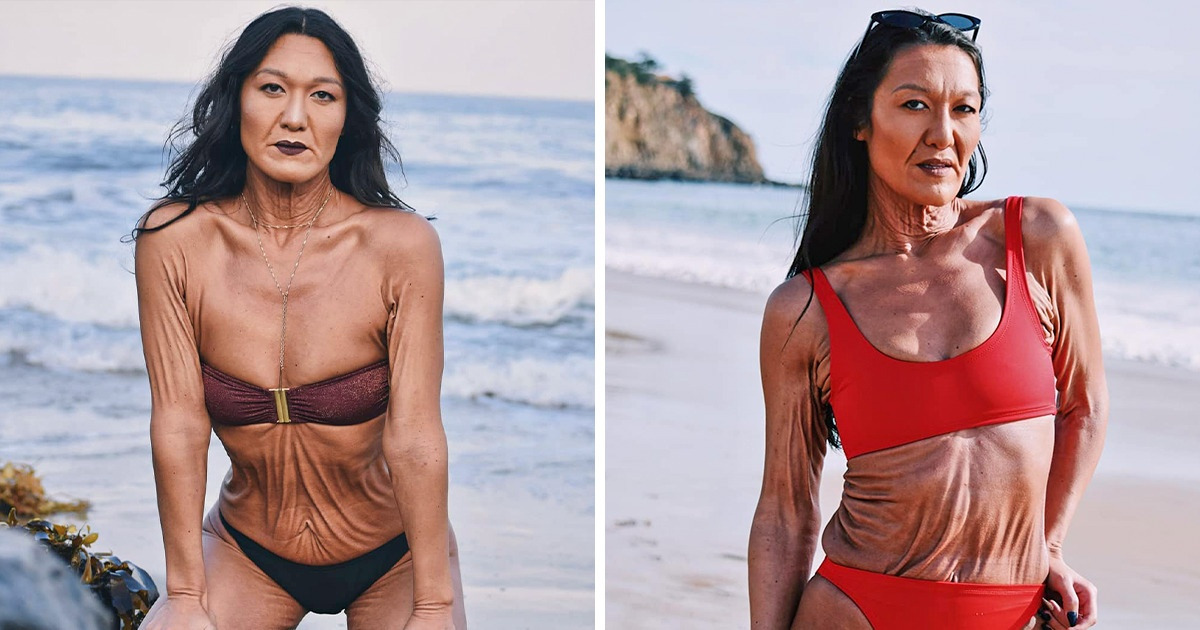 Voici lâhistoire de Sara Geurts, un mannequin de 31 ans atteint dâune maladie de peau rare
